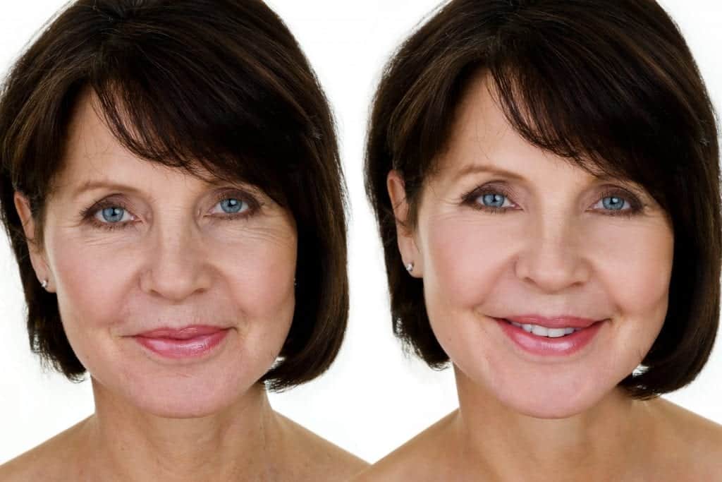 botulinum toxin - before and after