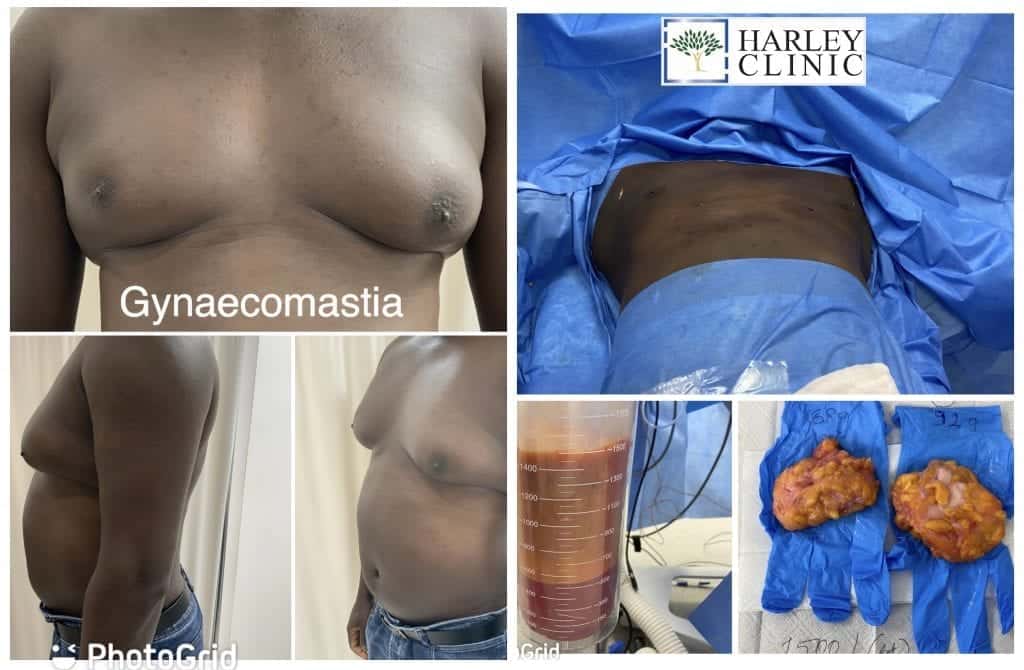 before and after Gynaecomastia at The Harley Clinic, London