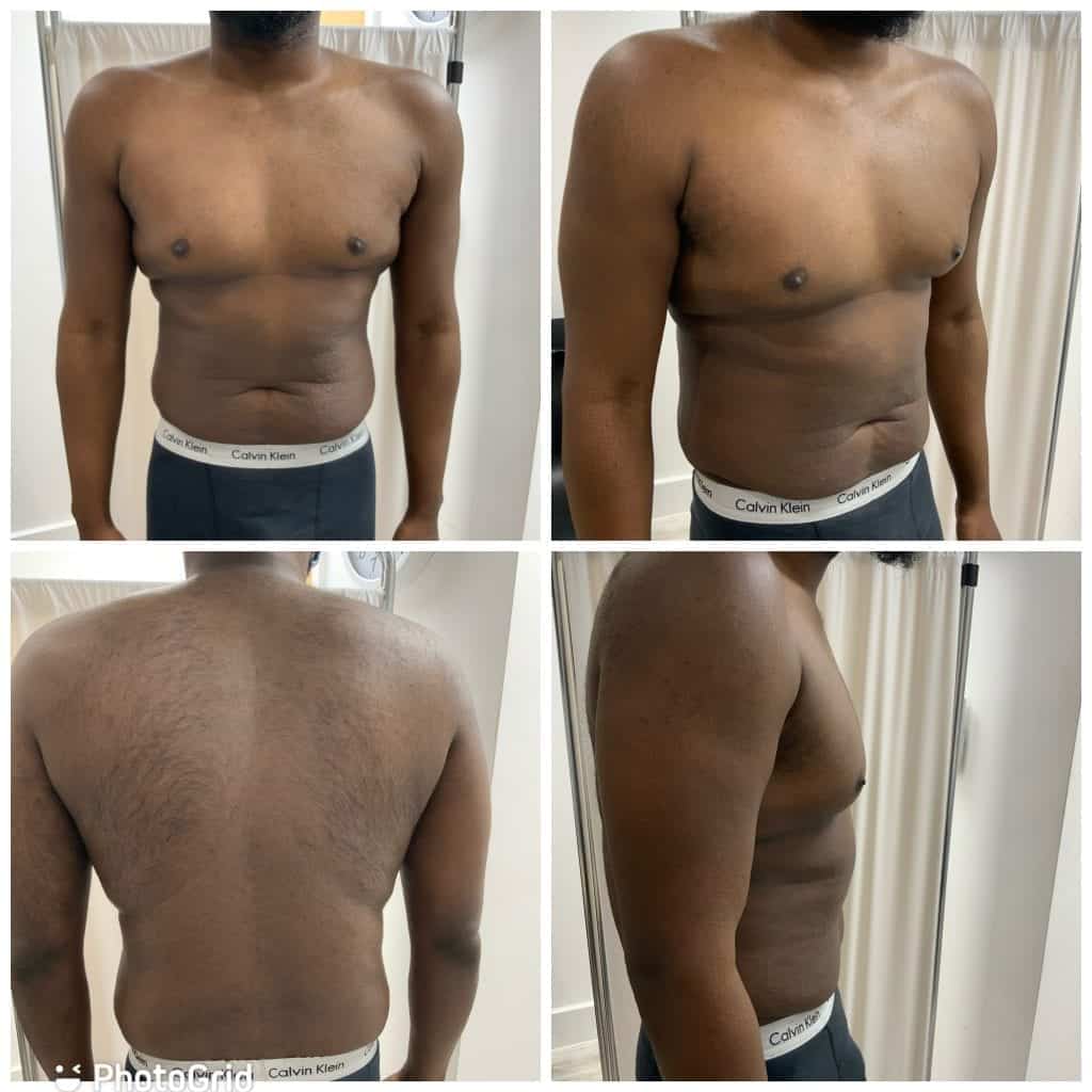 Before liposuction for men, The Harley Clinic, London