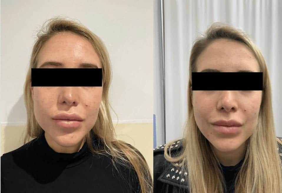 Buccal Fat Removal / cheek reduction surgery at The Harley Clinic, London