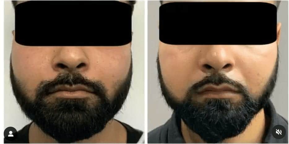 Cheek reduction surgery at The Harley Clinic, London