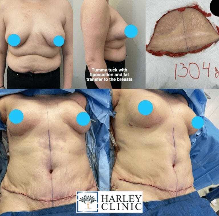 Tummy tuck with liposuction and breast augmentation fat transfer at The Harley Clinic, London