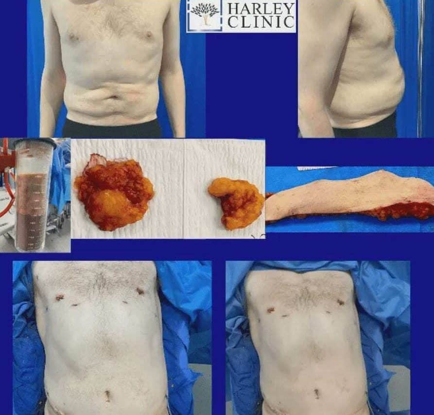 Male breast reduction surgery at The Harley Clinic