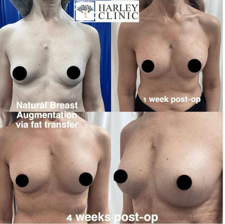 Fat transfer breast augmentation before and after photo