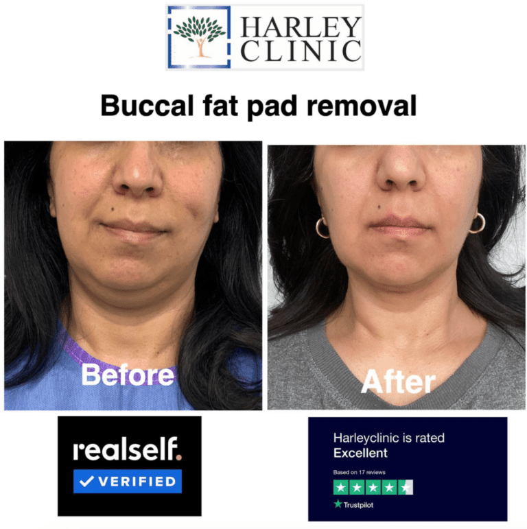 Before and after cheek reduction surgery at The Harley Clinic