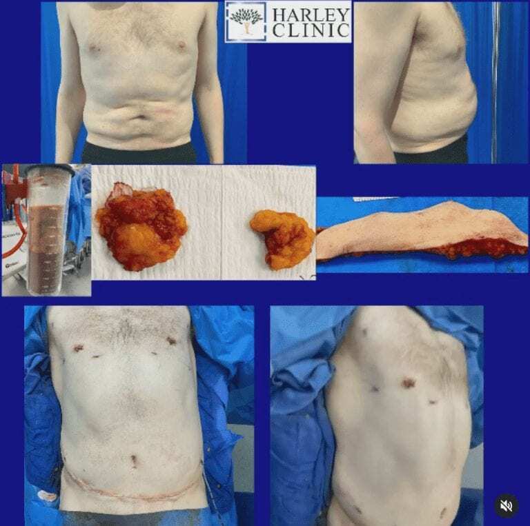Male breast reduction surgery and mini tummy tuck at The Harley Clinic, London