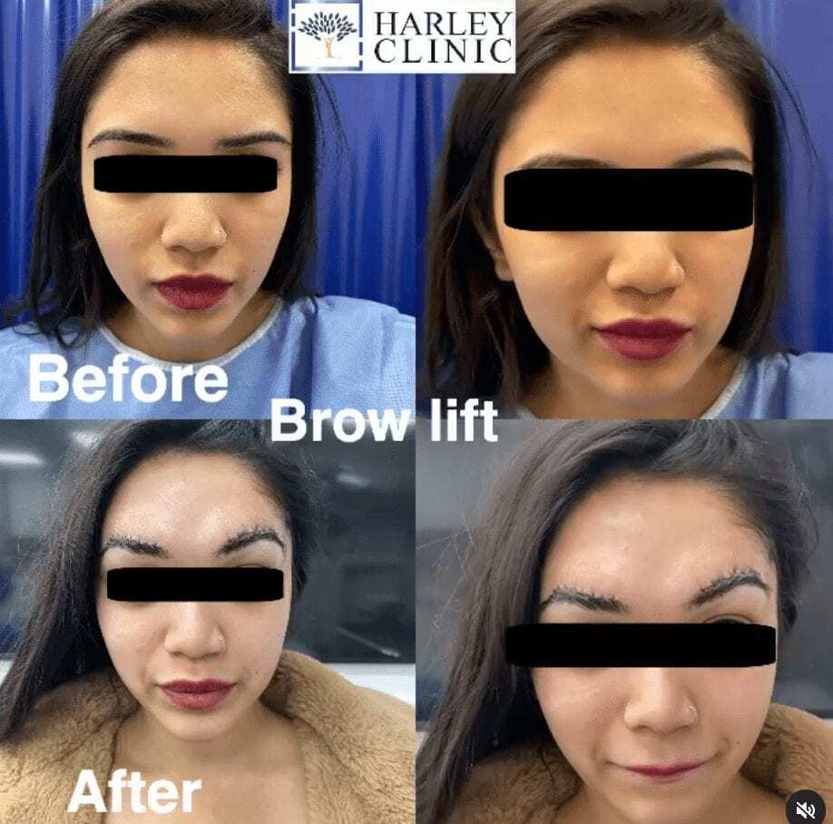 Before and after brow lift at The Harley Clinic, London
