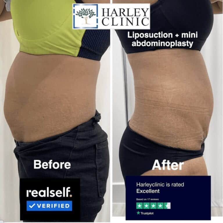 Before and after liposuction and mini tummy tuck at The Harley Clinic, London