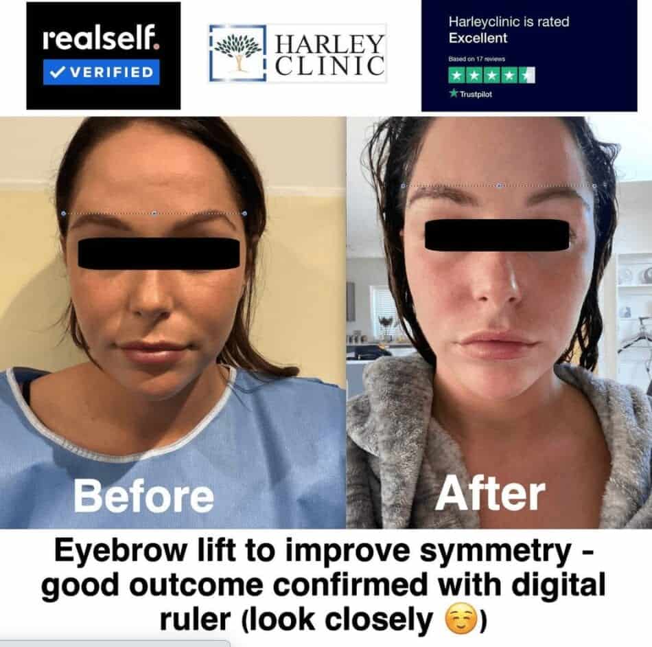 Antes y después del lifting de cejas para mejorar la simetría en Harley Clinic