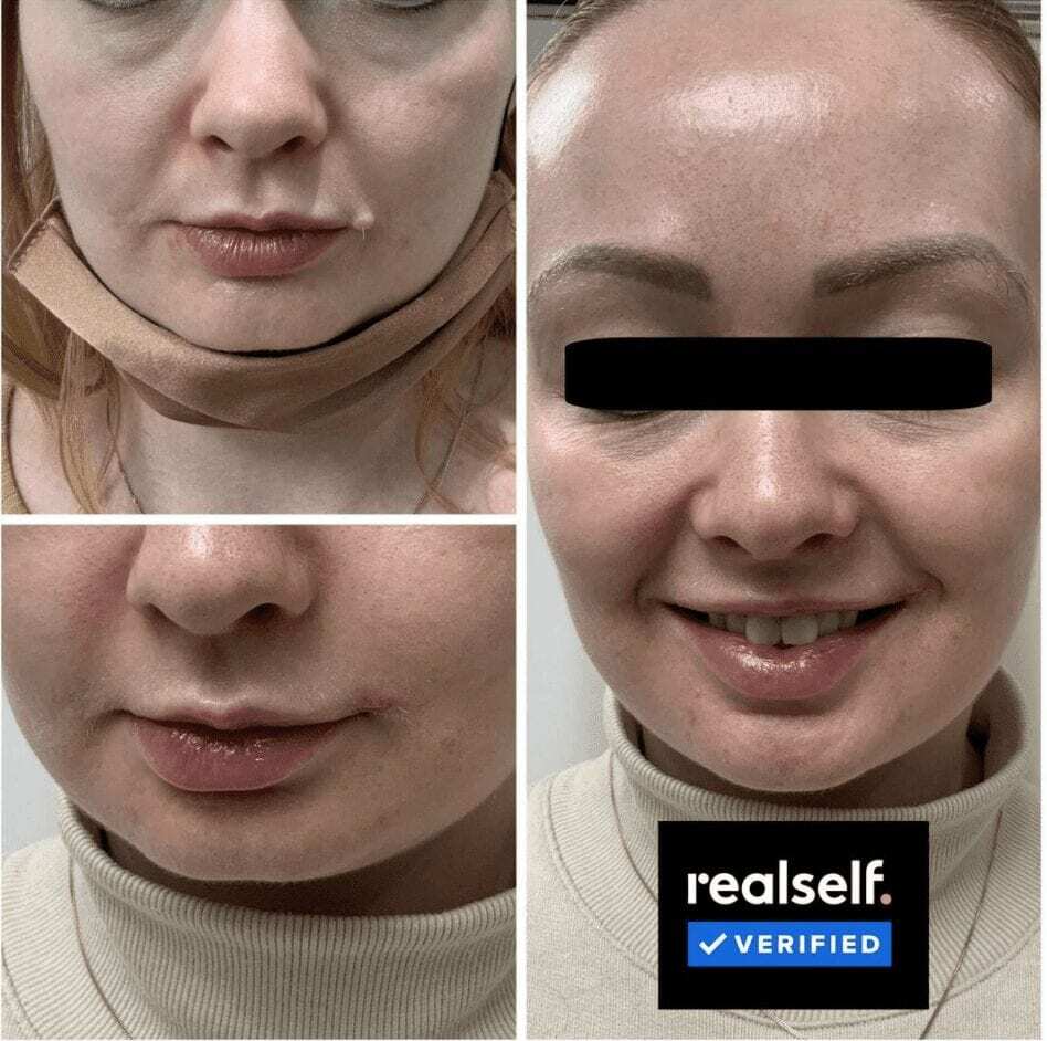 Mole removal before and after at The Harley Clinic