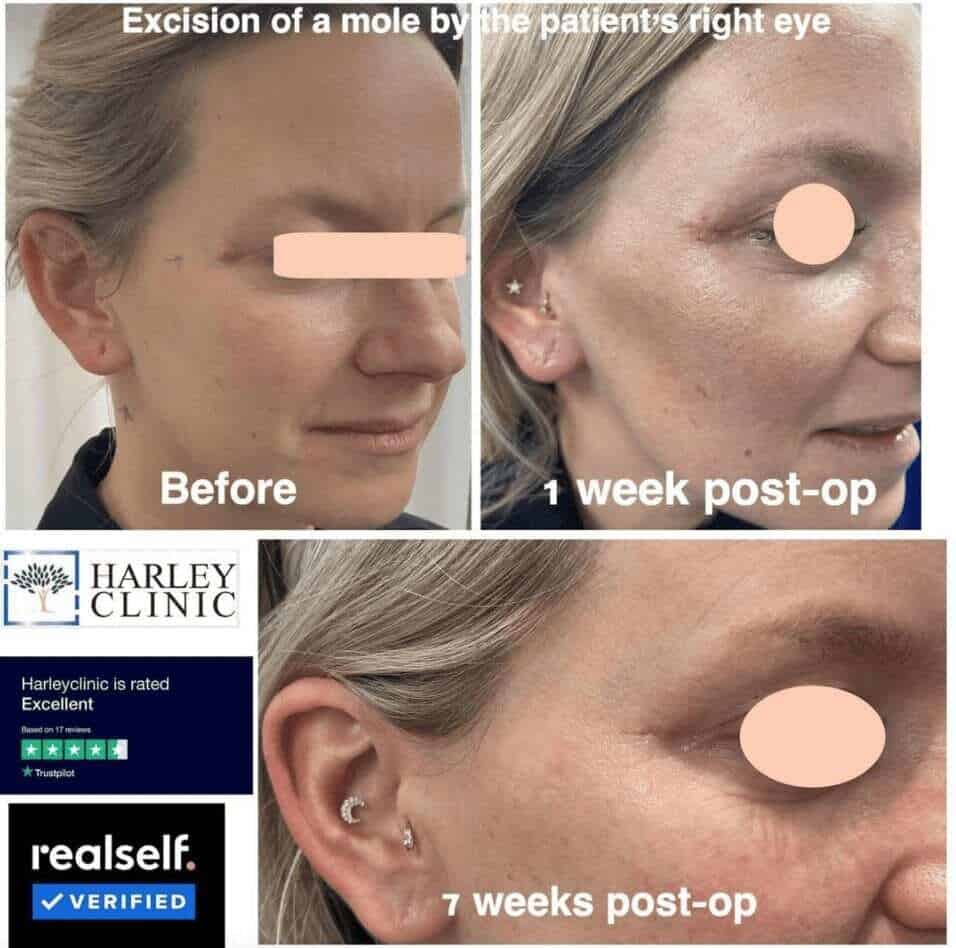 Mole removal 7 weeks post-op by the patient's right eye at The Harley Clinic, London