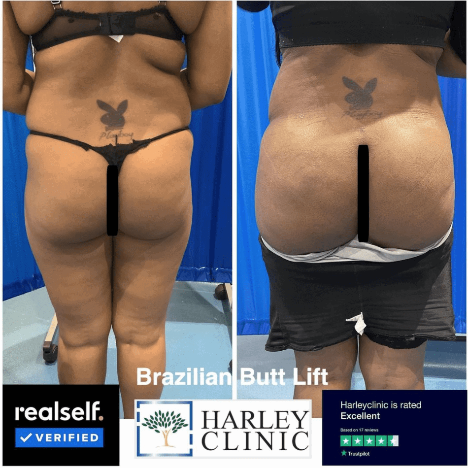 Before and after Brazilian butt lift surgery BBL, The Harley Clinic
