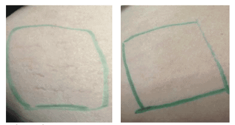 Stretch Marks - before and after treatment with Skin Pen Microneedling