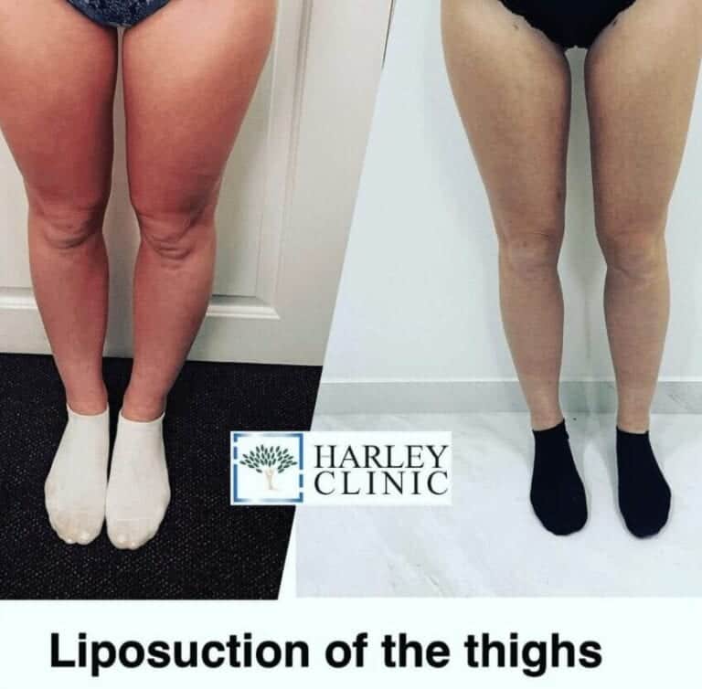 thigh liposuction at The Harley Clinic London