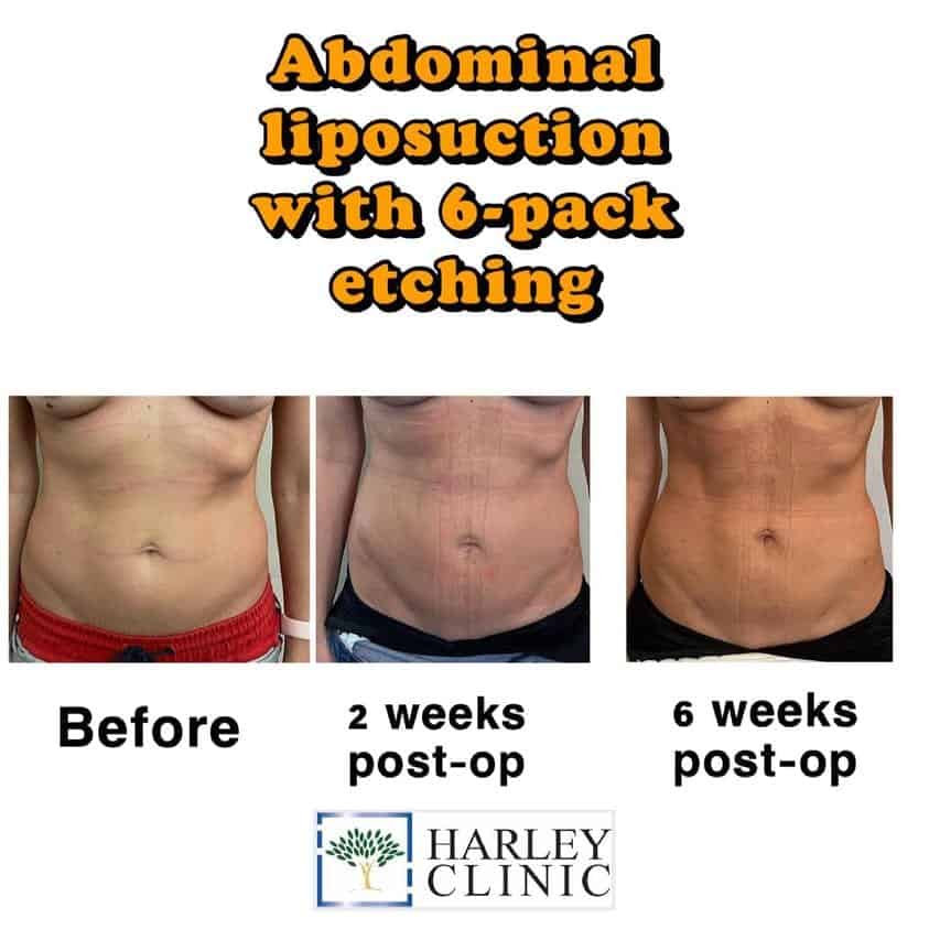 Abdominal liposuction with 6-pack etching before and after photos at The Harley Clinic, London