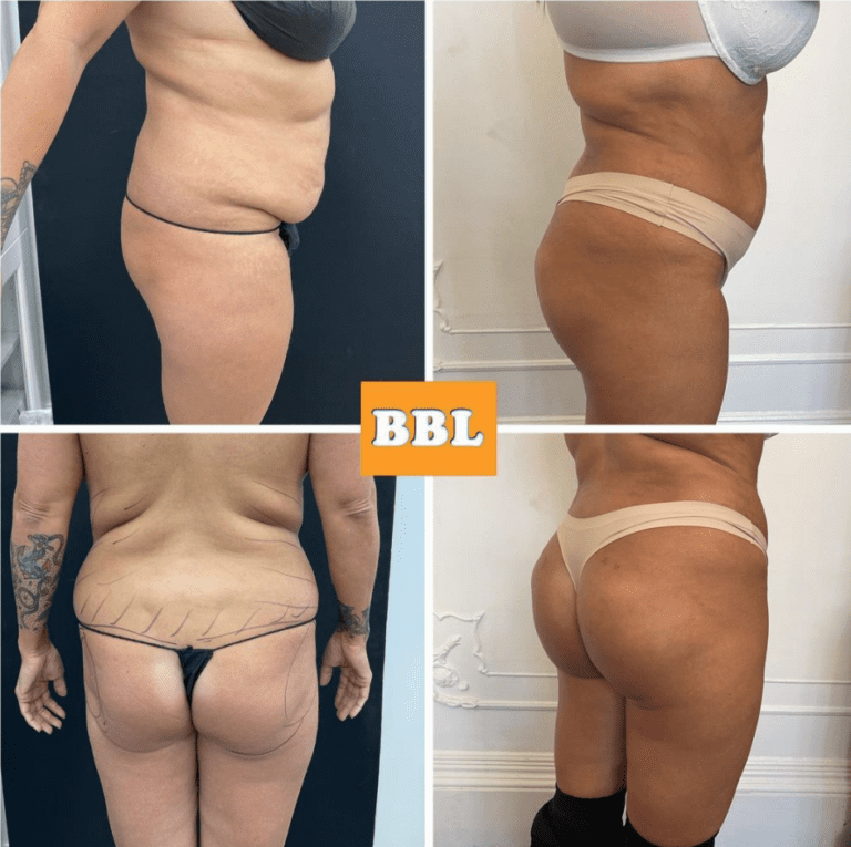BBL recovery before and after - Brazilian butt lift at The Harley Clinic, London