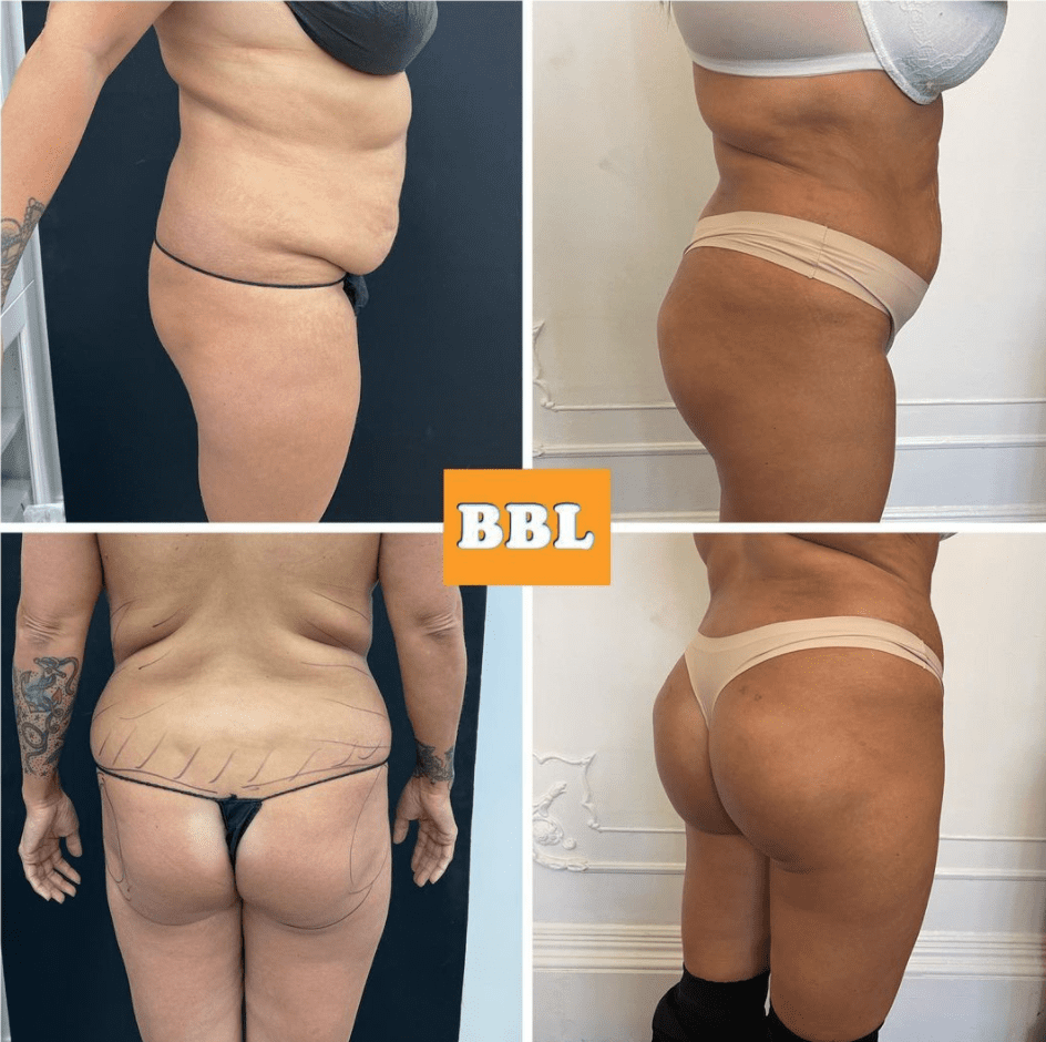BBL recovery before and after - Brazilian butt lift at The Harley Clinic, London