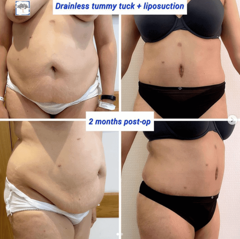 Drainless tummy tuck and liposuction at the Harley Clinic