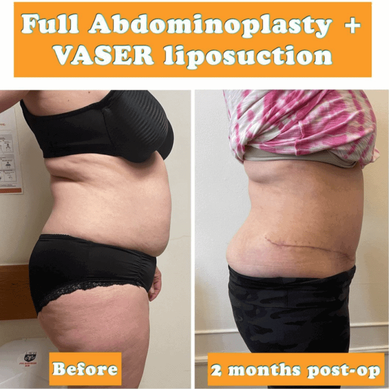 Full abdomnimoplasty and Vaser liposuction at The Harley Clinic, London