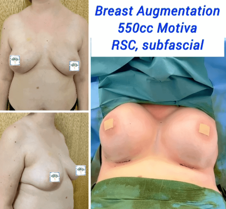 Breast augmentation 550cc Motiva at The Harley Clinic, London