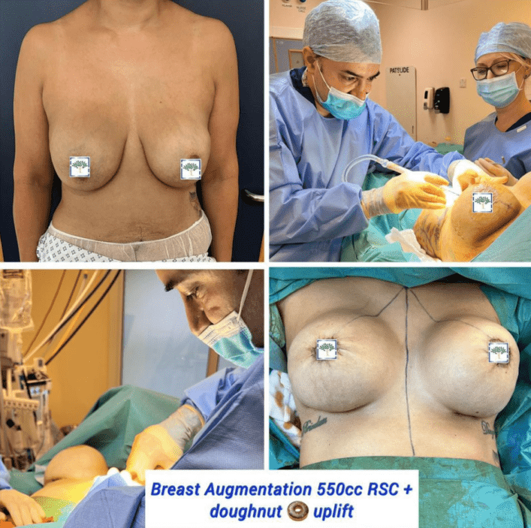 Breast augmentation and doughnut uplift at The Harley Clinic, London