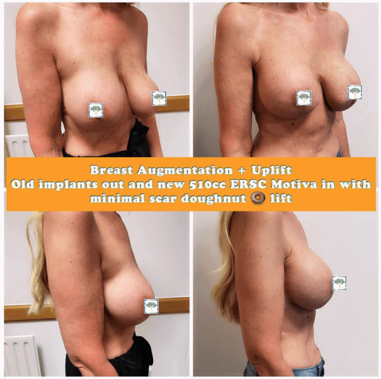 Breast augmentation and uplift with minimal scar, The Harley Clinic, London