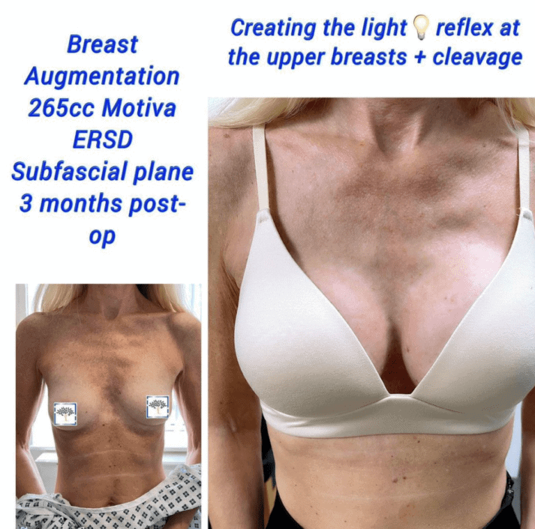 Breast augmentation, 265cc Motiva, 3 months post op, The Harley Clinic, London