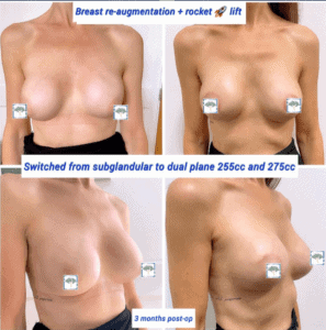 Breast re-augmentation and rocket lift at The Harley Clinic, London