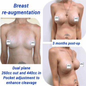 Breast re-augmentation 3 months post-op at The Harley Clinic, London