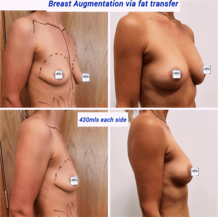 Breast augmentation via fat transfer at The Harley Clinic, London