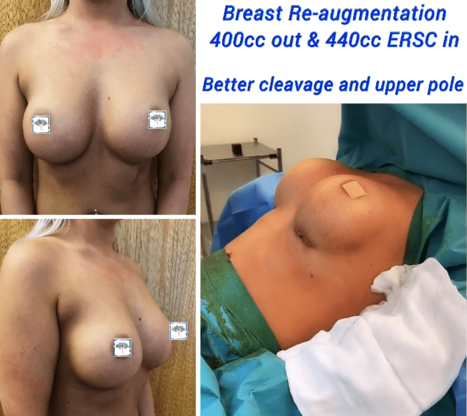 Breast re-augmentation at The Harley Clinic, London