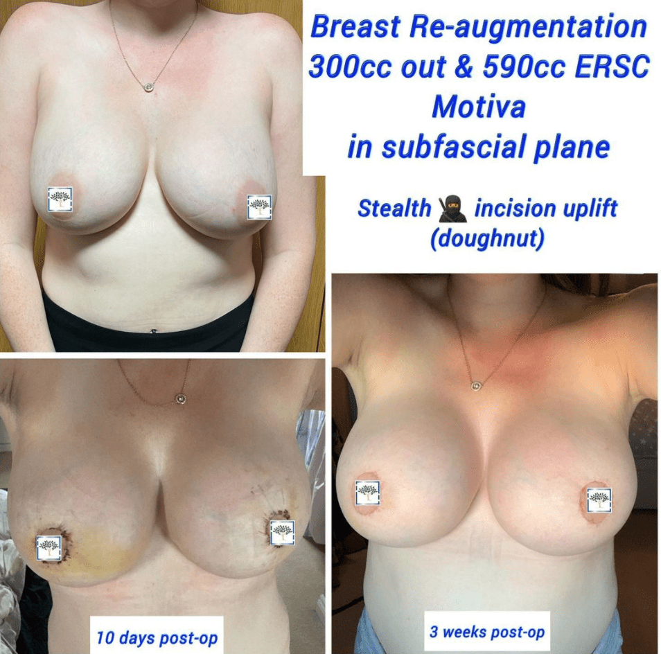 Breast re-augmentation and incision uplift, at the Harley Clinic, London