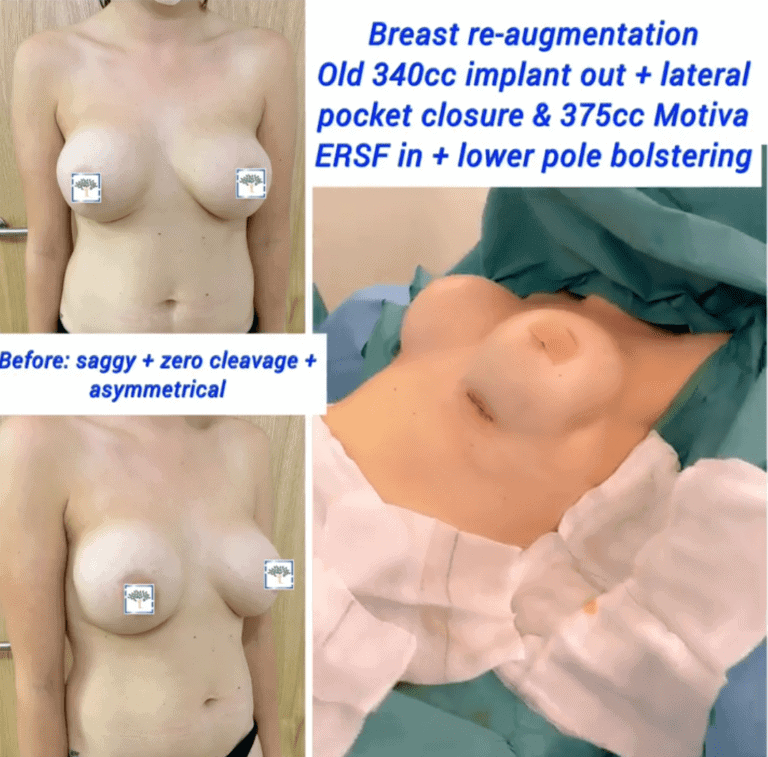 Breast re-augmentation, old implants out, 375cc Motiva in + lower pole bolstering at The Harley Clinic