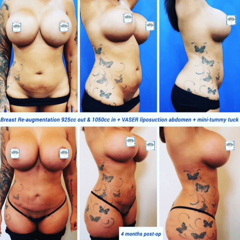 Breast re-augmentation, VASER liposuction, and tummy tuck - The Harley Clinic, London
