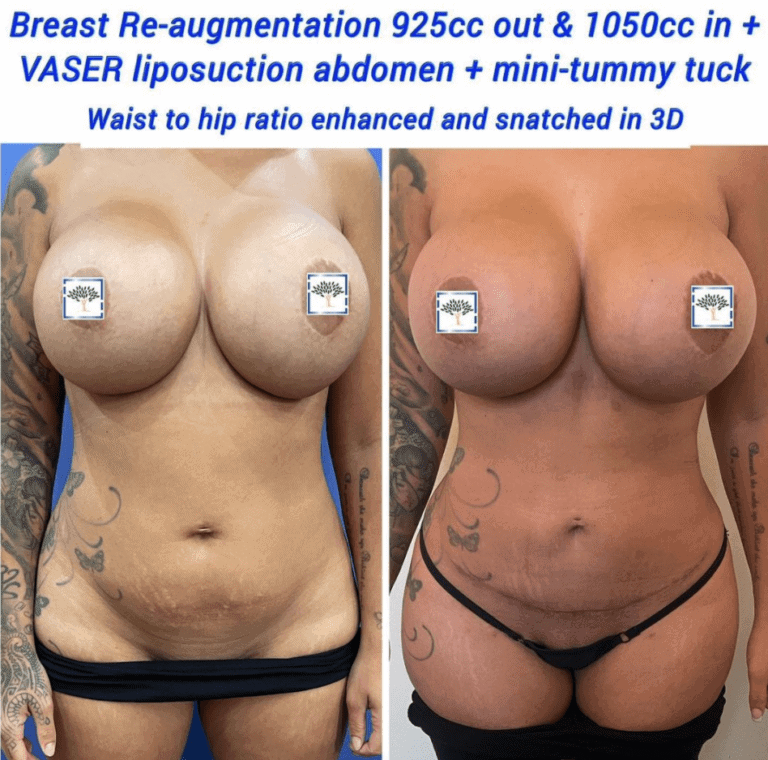 Breast re-augmentation, Vaser liposuction, mini tummy tuck at The Harley Clinic, London
