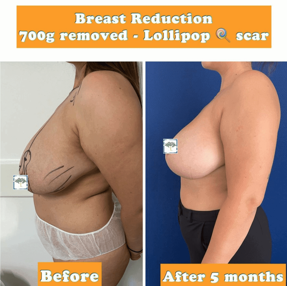 breast reduction, 700g removed and lollipop scar at the Harley Clinic
