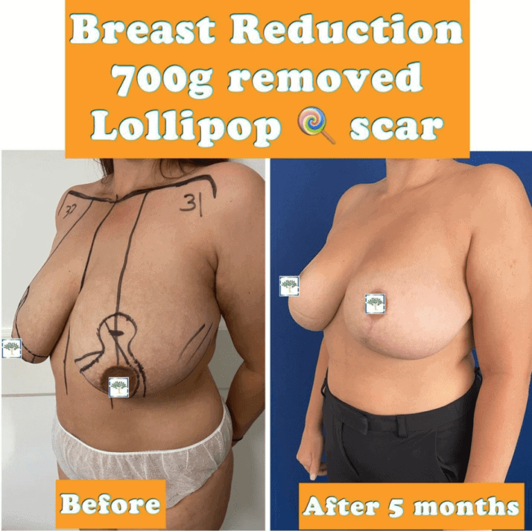 breast reduction at the Harley Clinic