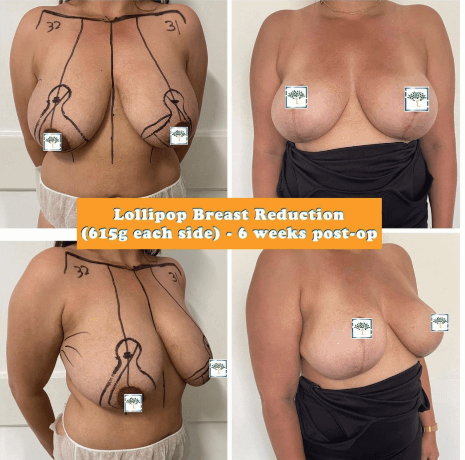 breast reduction before and after photos 6 weeks post-op at The Harley Clinic, London
