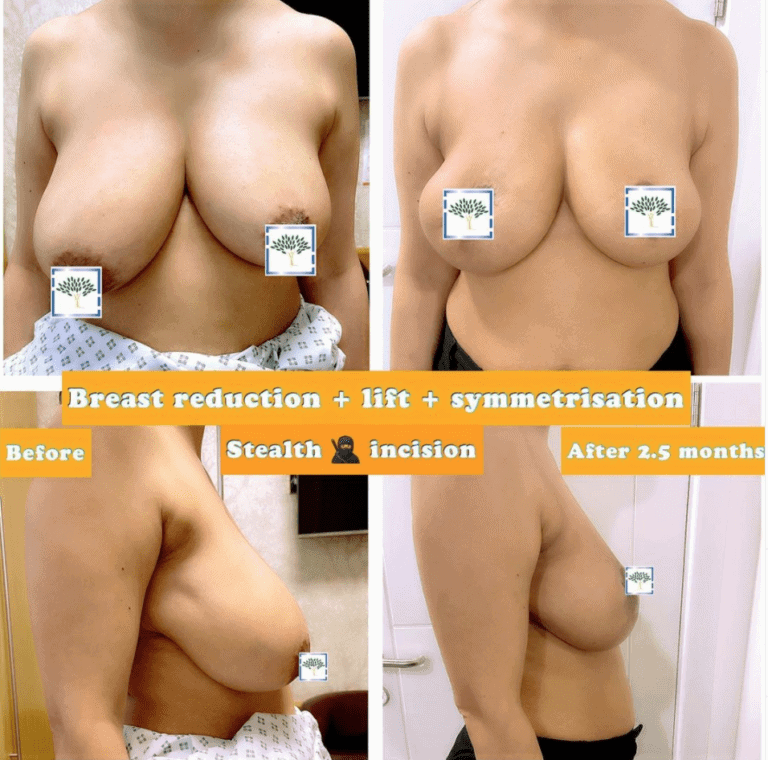 Breast surgery: breast reduction and lift and breast asymmetry correction 2.5 months post-op at The Harley Clinic, London