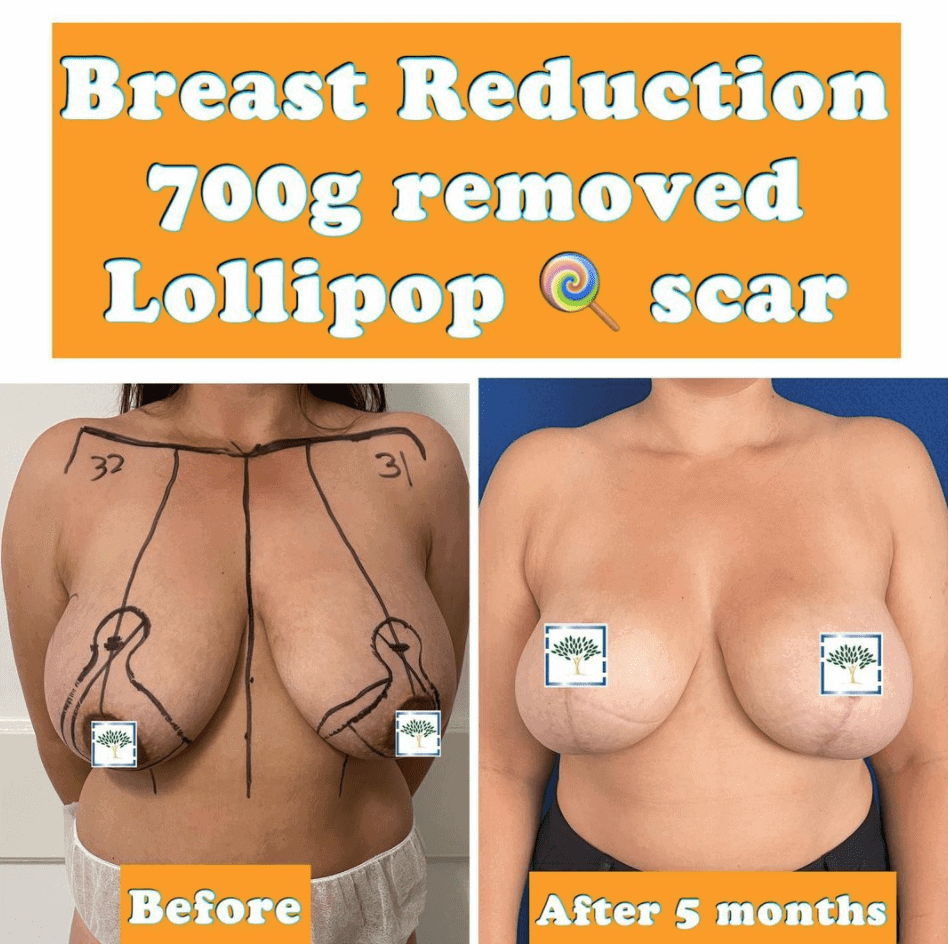 breast reduction, lollipop scar at the Harley Clinic