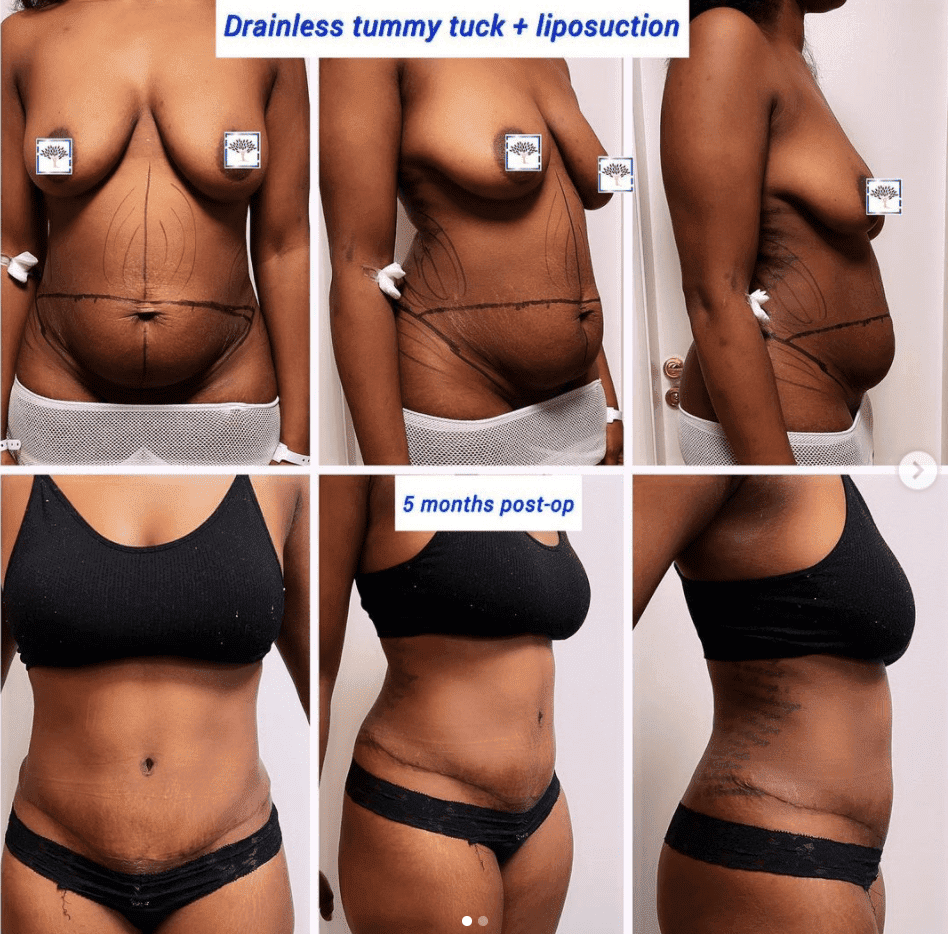Drainless tummy tuck and liposuction at The Harley Clinic, London