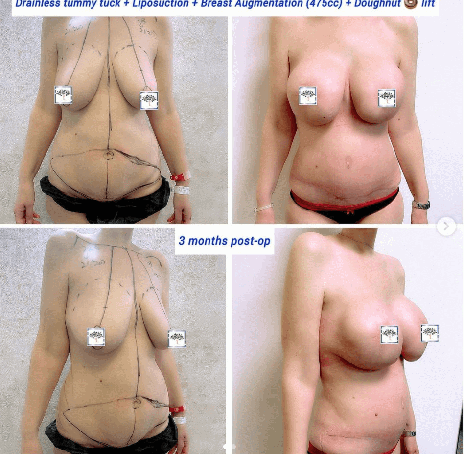 Drainless tummy tuck, liposuction, breast augmentation and doughnut lift at The Harley Clinic, London