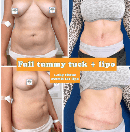 Full tummy tuck and liposuction - The Harley Clinic, London