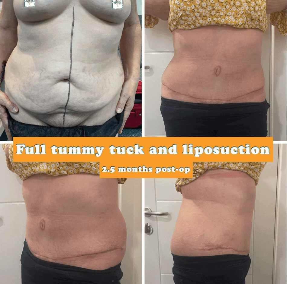 Full tummy tuck and liposuction at The Harley Clinic, London