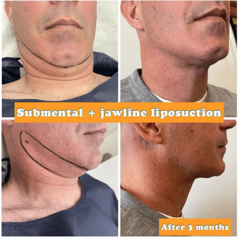 submental and jawline liposuction at The Harley Clinic, London