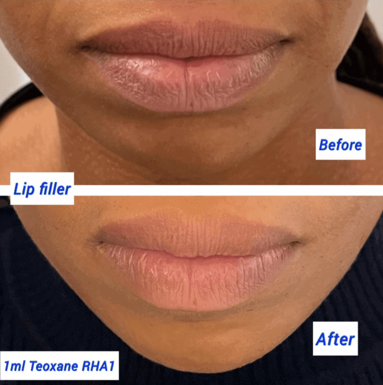 Before and after lip filler at The Harley Clinic, London