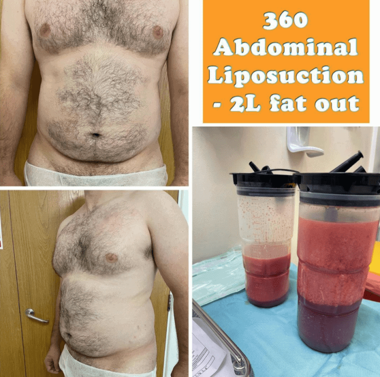 360 abdominal liposuction at The Harley Clinic, London