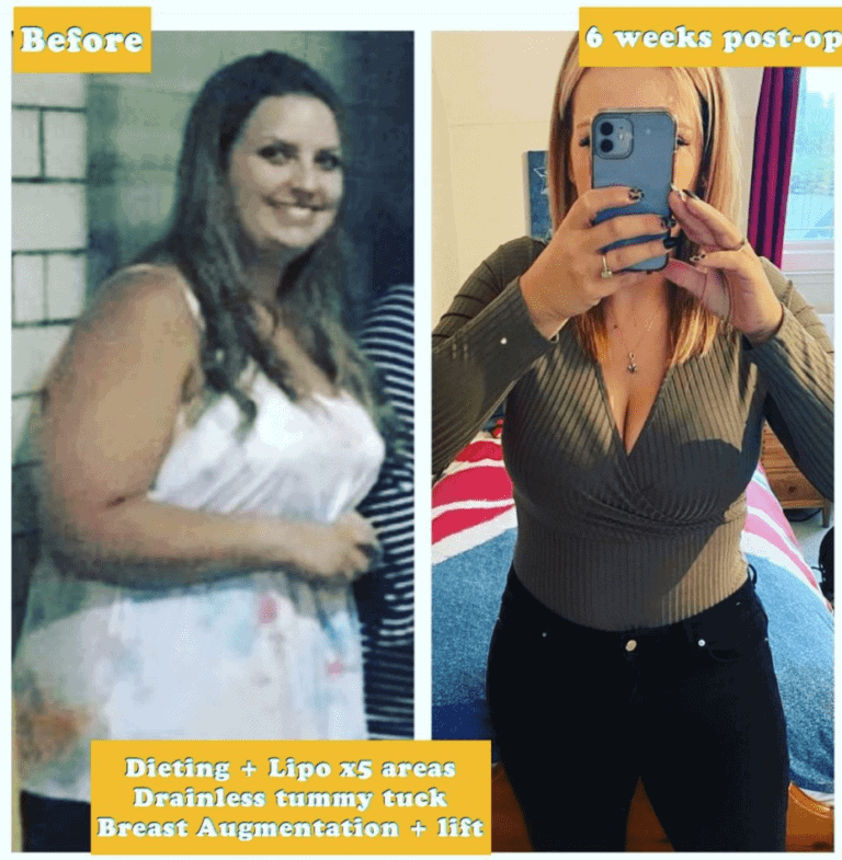 Surgery After Weight Loss: Before and after liposuction, dieting, drainless tummy tuck, breast augmentation, and lift at The Harley Clinic, London