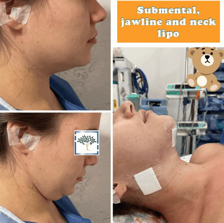 submental jawline and neck lipo at The Harley Clininc