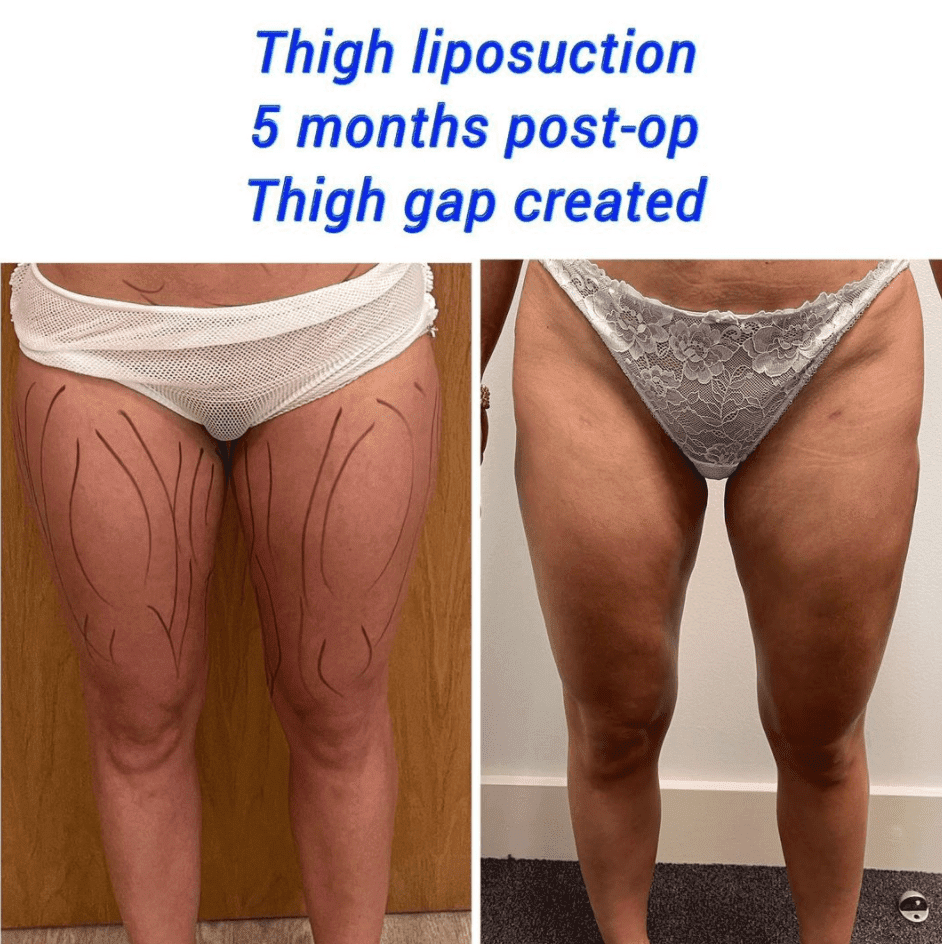 thigh liposuction 5 months post op at The Harley Clinic London